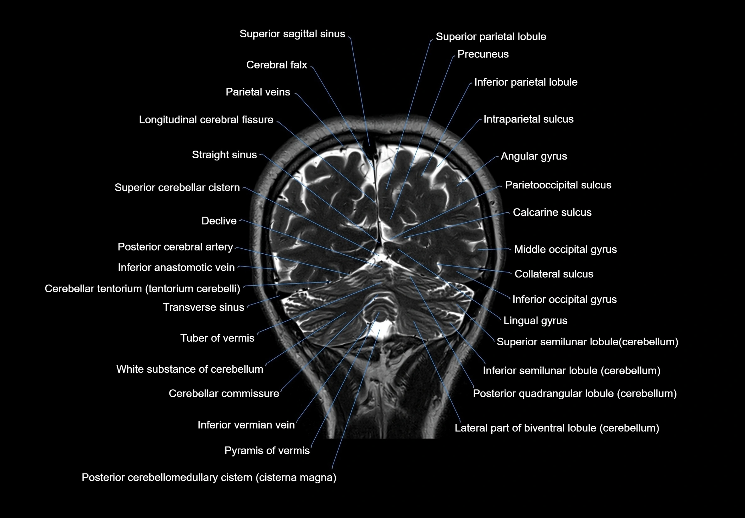 MRI Brain coronal cross sectional labelled anatomy 3T image  -img-00001-00059.webp